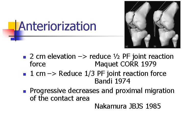 Anteriorization n 2 cm elevation –> reduce ½ PF joint reaction force Maquet CORR