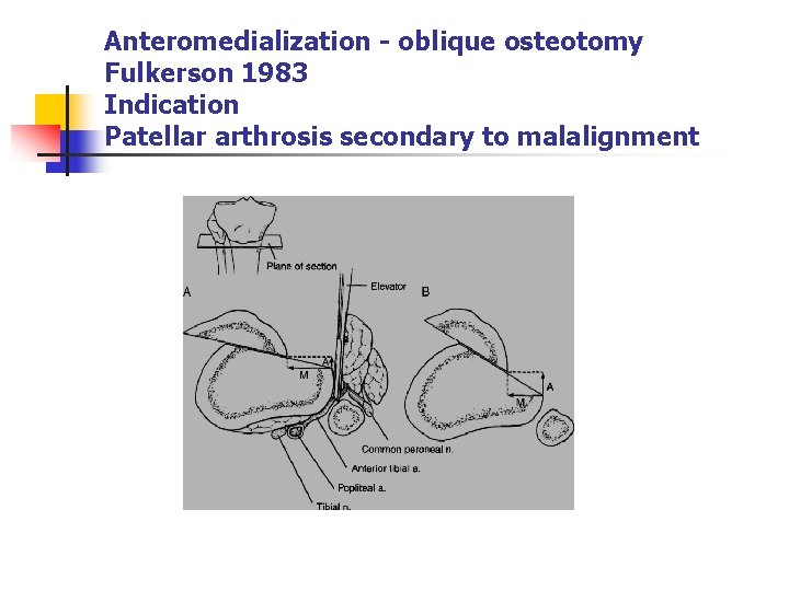 Anteromedialization - oblique osteotomy Fulkerson 1983 Indication Patellar arthrosis secondary to malalignment 