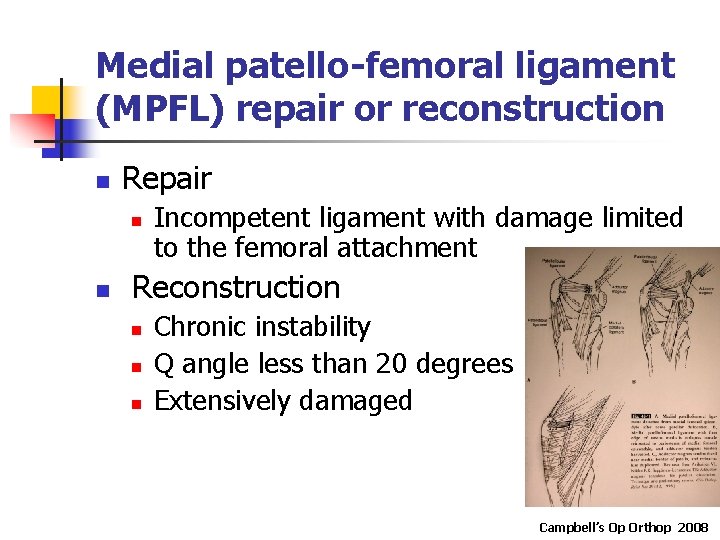 Medial patello-femoral ligament (MPFL) repair or reconstruction n Repair n n Incompetent ligament with