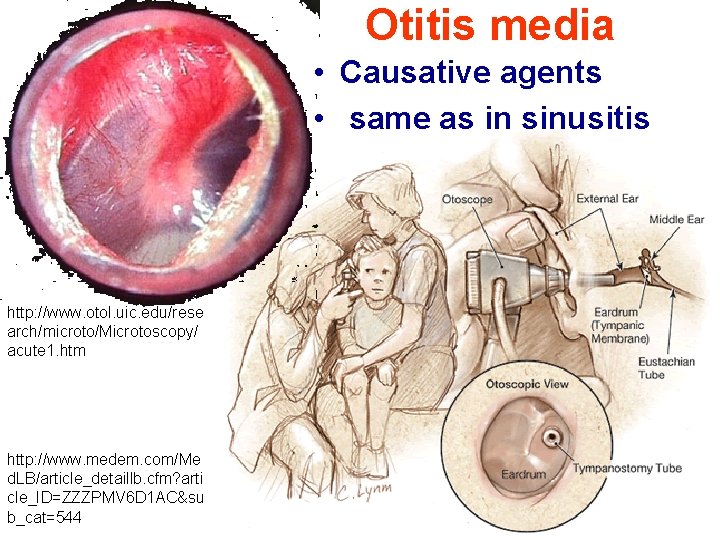 Otitis media • Causative agents • same as in sinusitis http: //www. otol. uic.