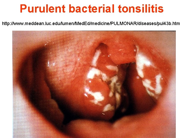 Purulent bacterial tonsilitis http: //www. meddean. luc. edu/lumen/Med. Ed/medicine/PULMONAR/diseases/pul 43 b. htm 