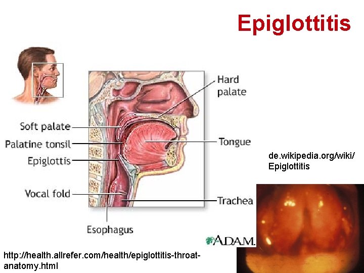 Epiglottitis de. wikipedia. org/wiki/ Epiglottitis http: //health. allrefer. com/health/epiglottitis-throatanatomy. html 