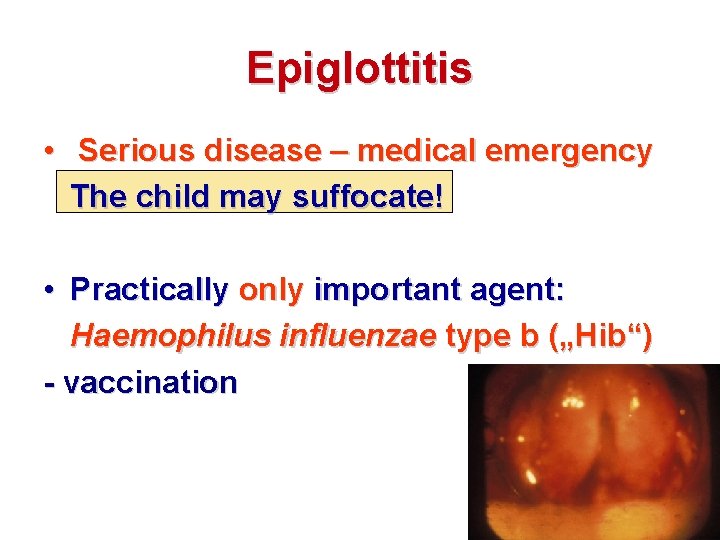 Epiglottitis • Serious disease – medical emergency The child may suffocate! • Practically only
