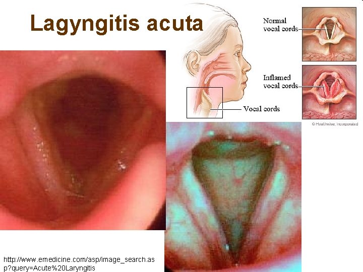 Lagyngitis acuta http: //www. emedicine. com/asp/image_search. as p? query=Acute%20 Laryngitis 