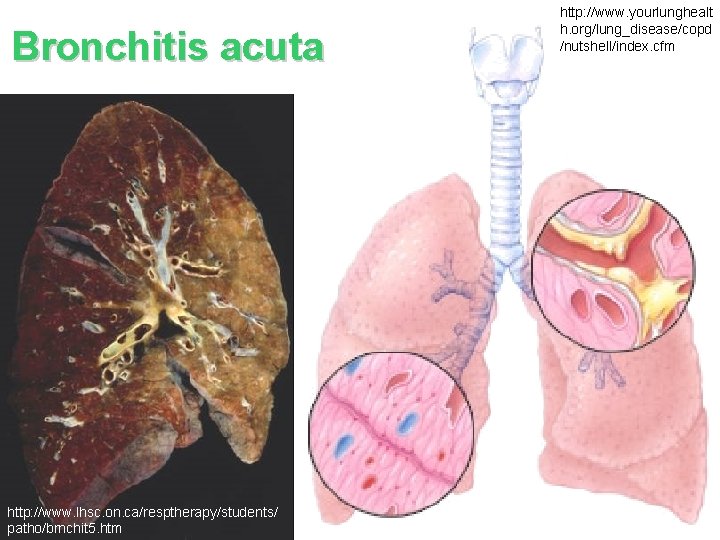 Bronchitis acuta http: //www. lhsc. on. ca/resptherapy/students/ patho/brnchit 5. htm http: //www. yourlunghealt h.