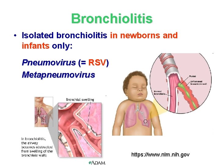 Bronchiolitis • Isolated bronchiolitis in newborns and infants only: Pneumovirus (= RSV) Metapneumovirus https: