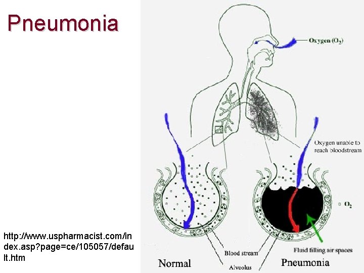 Pneumonia http: //www. uspharmacist. com/in dex. asp? page=ce/105057/defau lt. htm 