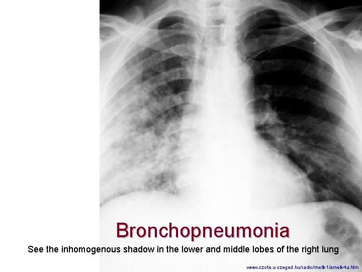 Bronchopneumonia See the inhomogenous shadow in the lower and middle lobes of the right