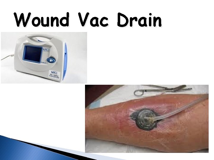 Wound Vac Drain 