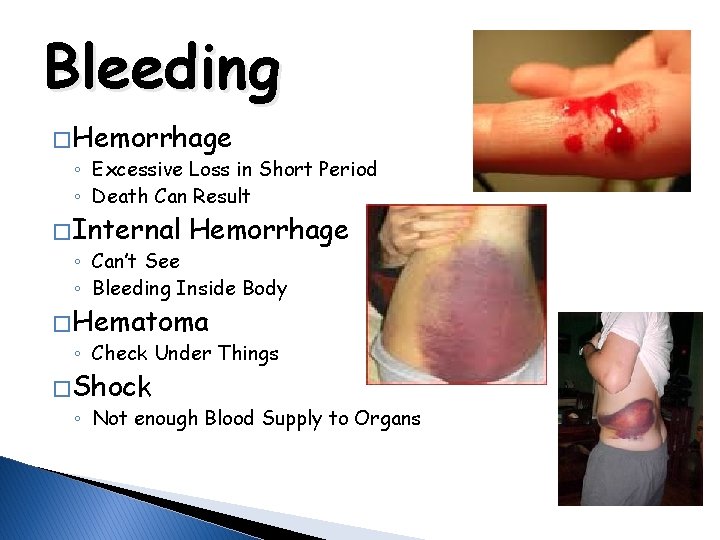 Bleeding � Hemorrhage ◦ Excessive Loss in Short Period ◦ Death Can Result �