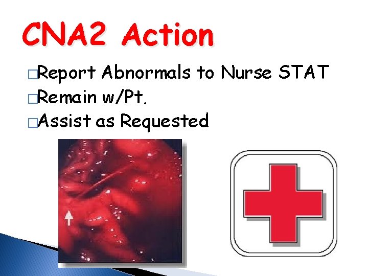 CNA 2 Action �Report Abnormals to Nurse STAT �Remain w/Pt. �Assist as Requested 