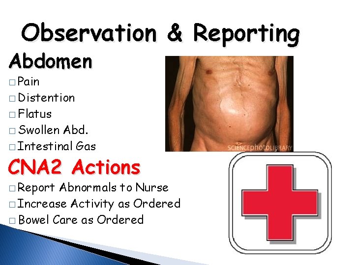 Observation & Reporting Abdomen � Pain � Distention � Flatus � Swollen Abd. �