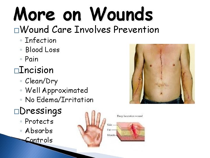 More on Wounds �Wound Care Involves Prevention ◦ Infection ◦ Blood Loss ◦ Pain