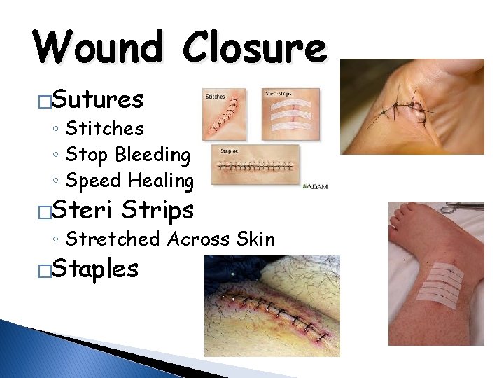 Wound Closure �Sutures ◦ Stitches ◦ Stop Bleeding ◦ Speed Healing �Steri Strips ◦