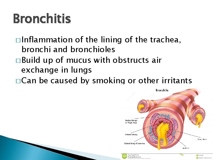 Bronchitis � Inflammation of the lining of the trachea, bronchi and bronchioles � Build