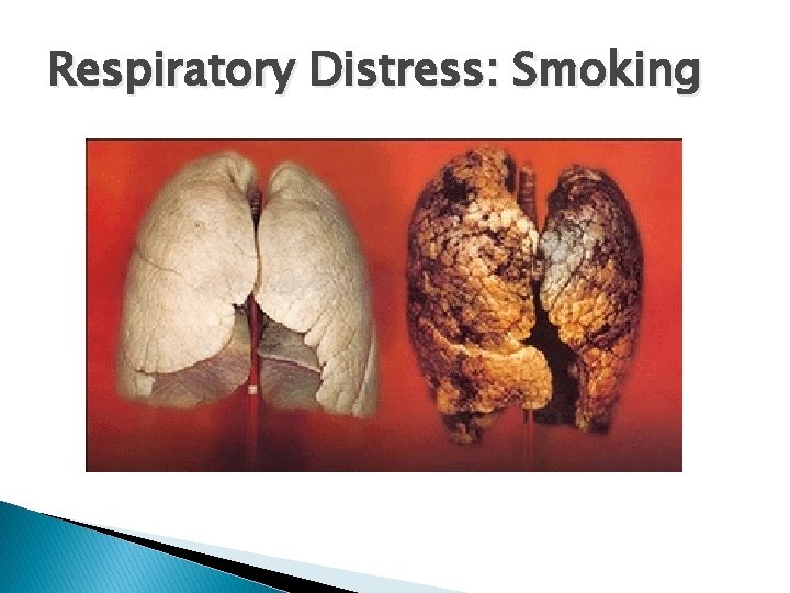 Respiratory Distress: Smoking 