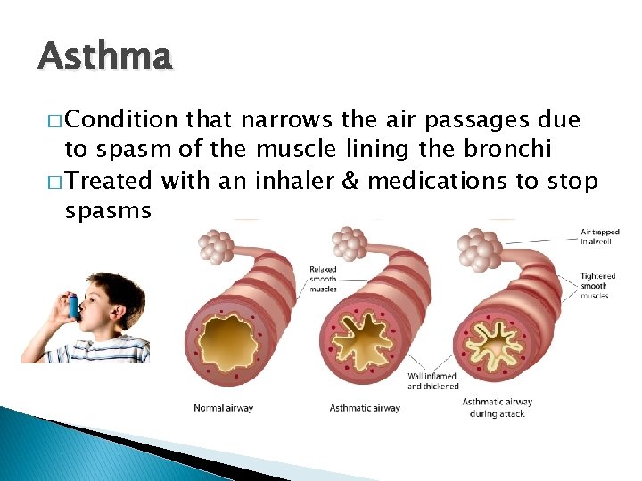 Asthma � Condition that narrows the air passages due to spasm of the muscle