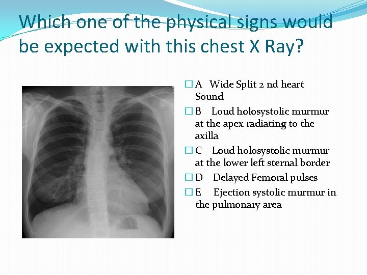 Which one of the physical signs would be expected with this chest X Ray?