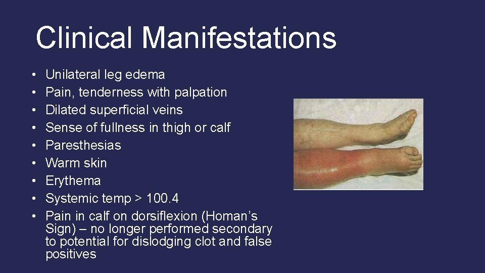 Clinical Manifestations • • • Unilateral leg edema Pain, tenderness with palpation Dilated superficial Clinical Manifestations • • • Unilateral leg edema Pain, tenderness with palpation Dilated superficial
