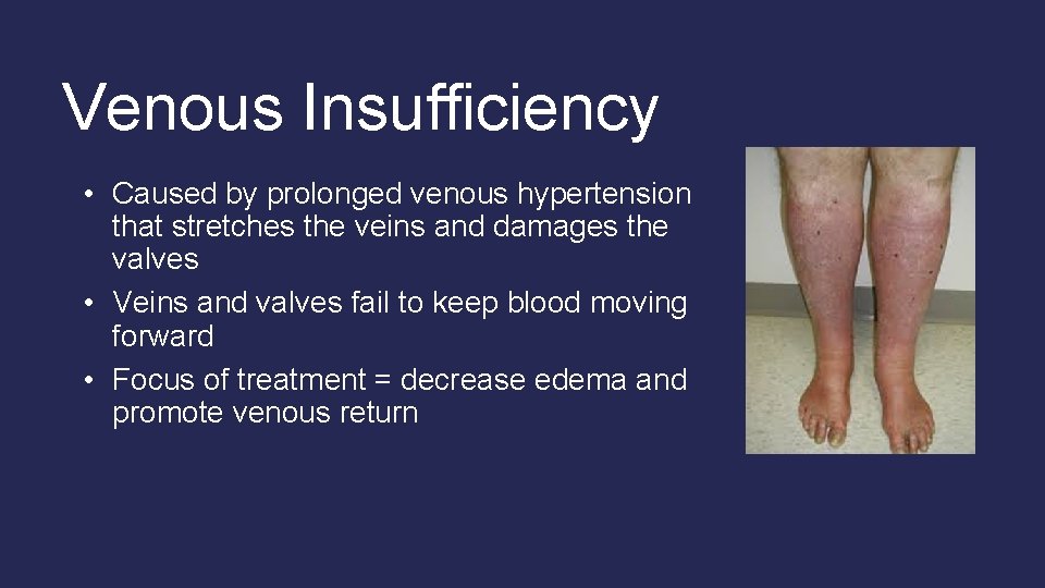 Venous Insufficiency • Caused by prolonged venous hypertension that stretches the veins and damages Venous Insufficiency • Caused by prolonged venous hypertension that stretches the veins and damages