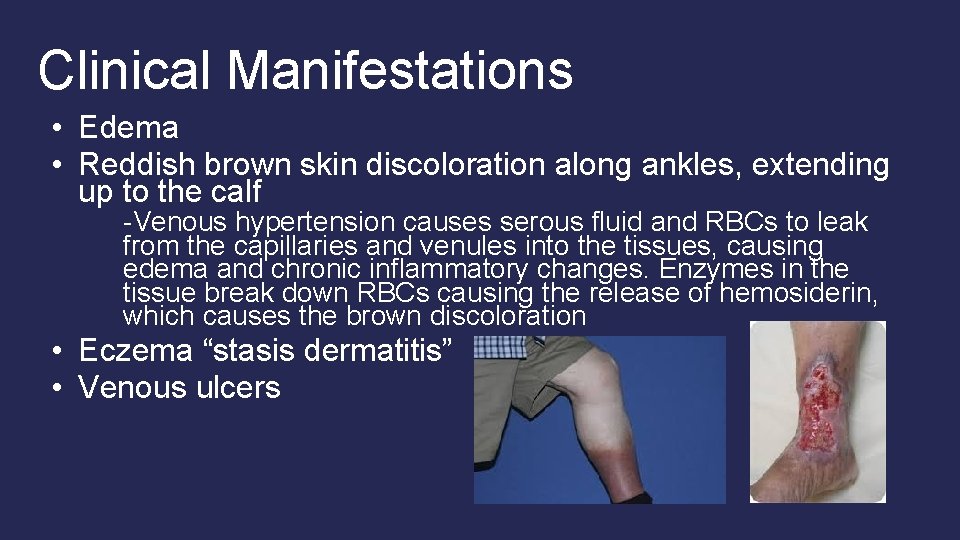 Clinical Manifestations • Edema • Reddish brown skin discoloration along ankles, extending up to Clinical Manifestations • Edema • Reddish brown skin discoloration along ankles, extending up to