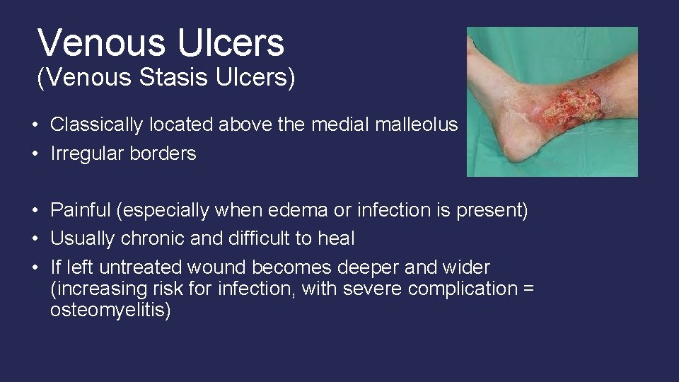 Venous Ulcers (Venous Stasis Ulcers) • Classically located above the medial malleolus • Irregular Venous Ulcers (Venous Stasis Ulcers) • Classically located above the medial malleolus • Irregular