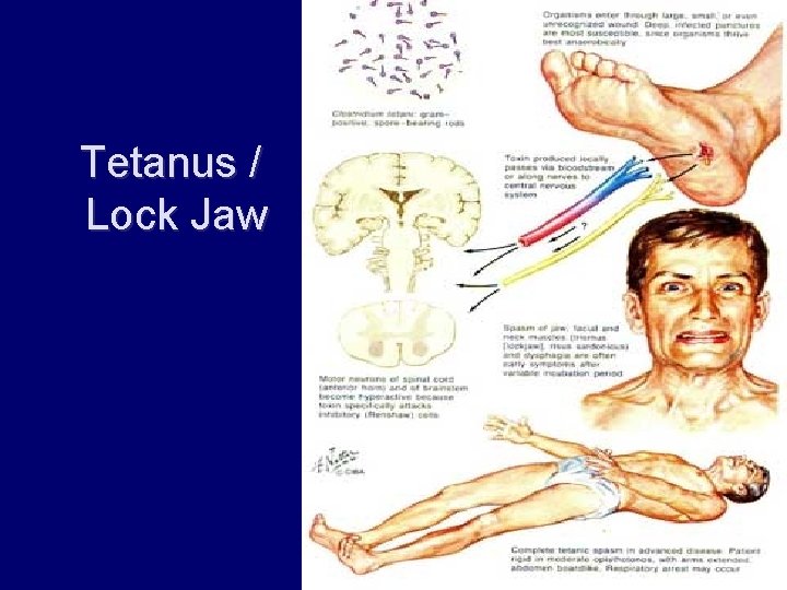 Tetanus / Lock Jaw 