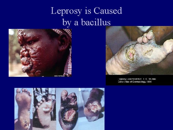 Leprosy is Caused by a bacillus 