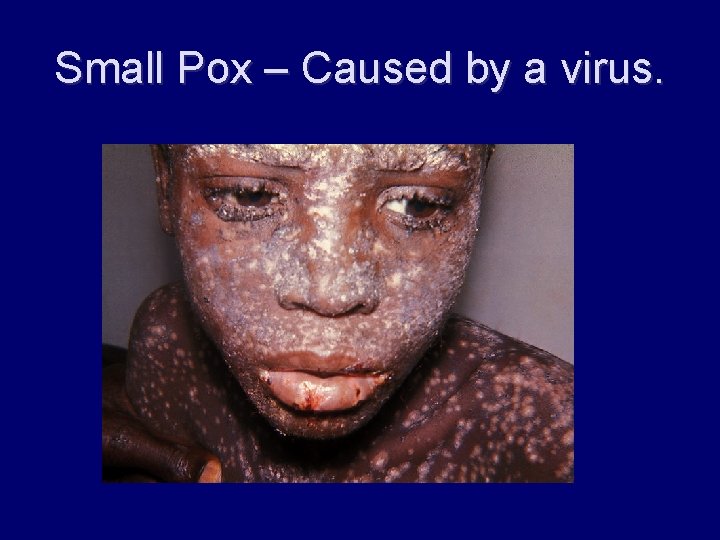 Small Pox – Caused by a virus. 