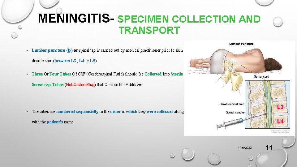 MENINGITIS- SPECIMEN COLLECTION AND TRANSPORT • Lumbar puncture (lp) or spinal tap is carried