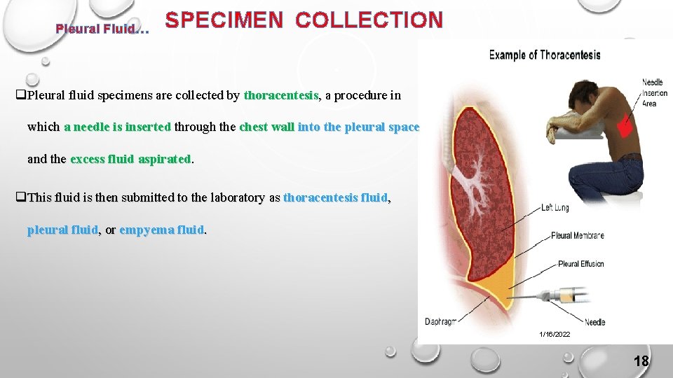 Pleural Fluid… SPECIMEN COLLECTION q Pleural fluid specimens are collected by thoracentesis, a procedure