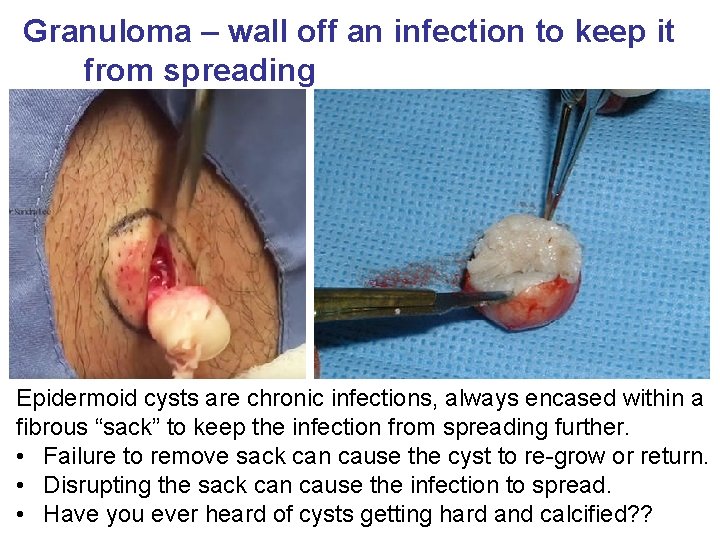 Granuloma – wall off an infection to keep it from spreading Epidermoid cysts are