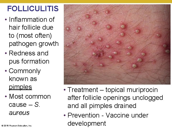 FOLLICULITIS • Inflammation of hair follicle due to (most often) pathogen growth • Redness