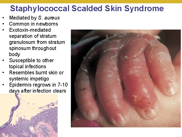 Staphylococcal Scalded Skin Syndrome • Mediated by S. aureus • Common in newborns •