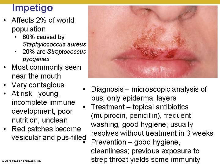 Impetigo • Affects 2% of world population • 80% caused by Staphylococcus aureus •