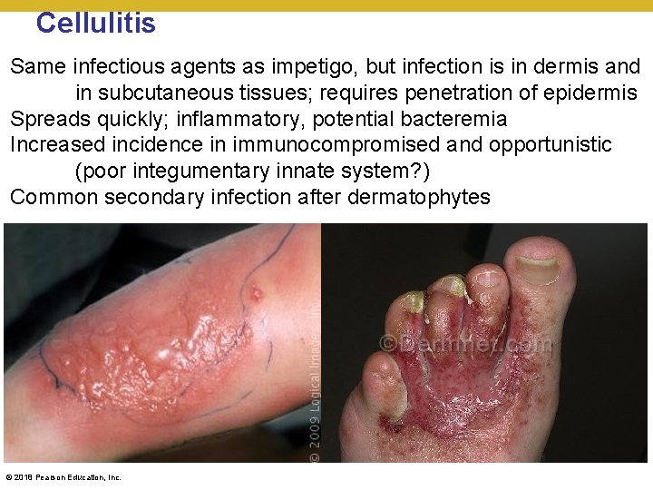 Cellulitis Same infectious agents as impetigo, but infection is in dermis and in subcutaneous