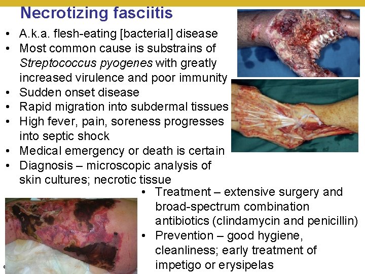 Necrotizing fasciitis • A. k. a. flesh-eating [bacterial] disease • Most common cause is
