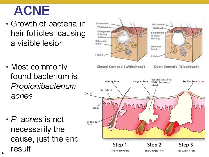 ACNE • Growth of bacteria in hair follicles, causing a visible lesion • Most