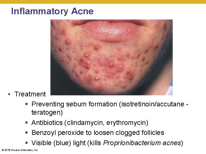 Inflammatory Acne • Treatment § Preventing sebum formation (isotretinoin/accutane teratogen) § Antibiotics (clindamycin, erythromycin)