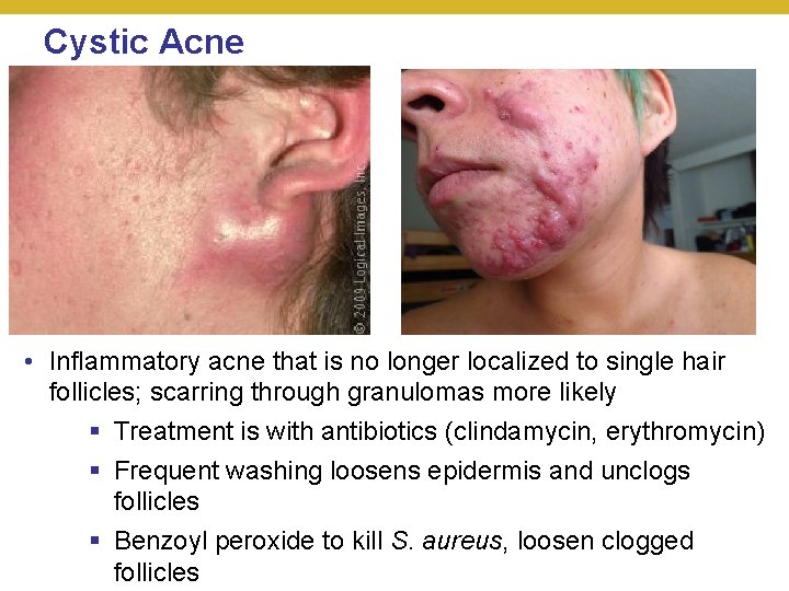 Cystic Acne • Inflammatory acne that is no longer localized to single hair follicles;
