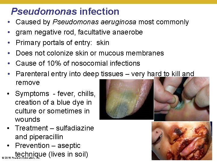 Pseudomonas infection • • • Caused by Pseudomonas aeruginosa most commonly gram negative rod,
