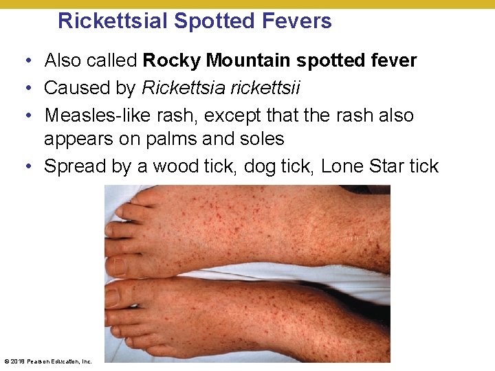 Rickettsial Spotted Fevers • Also called Rocky Mountain spotted fever • Caused by Rickettsia