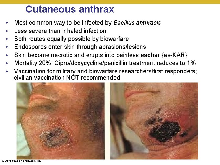 Cutaneous anthrax • • Most common way to be infected by Bacillus anthracis Less