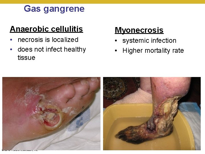 Gas gangrene Anaerobic cellulitis Myonecrosis • necrosis is localized • does not infect healthy