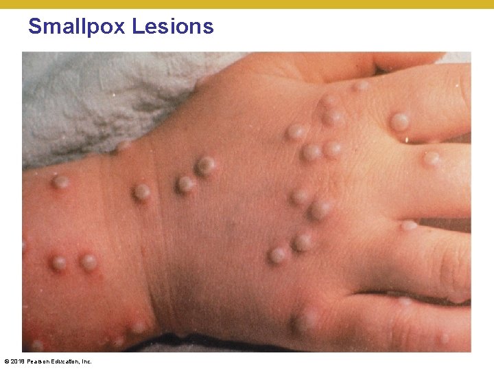 Smallpox Lesions © 2018 Pearson Education, Inc. 