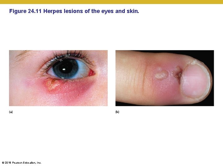Figure 24. 11 Herpes lesions of the eyes and skin. © 2018 Pearson Education,