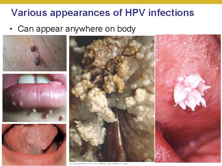 Various appearances of HPV infections • Can appear anywhere on body © 2018 Pearson