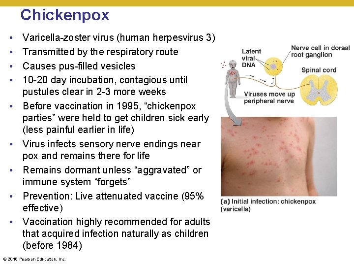 Chickenpox • • • Varicella-zoster virus (human herpesvirus 3) Transmitted by the respiratory route