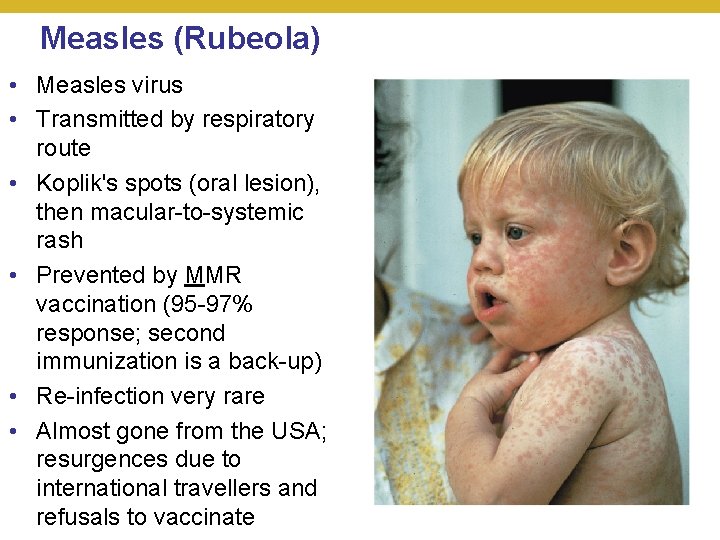 Measles (Rubeola) • Measles virus • Transmitted by respiratory route • Koplik's spots (oral