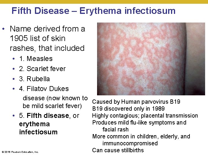 Fifth Disease – Erythema infectiosum • Name derived from a 1905 list of skin